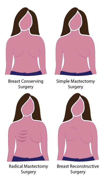Blog  The Mastectomy Store